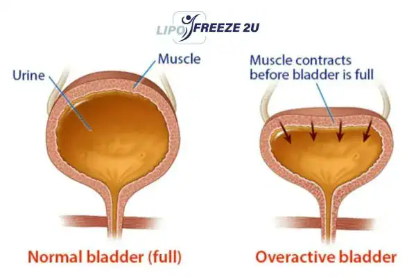 diagram of overactive bladder treatment Dorchester