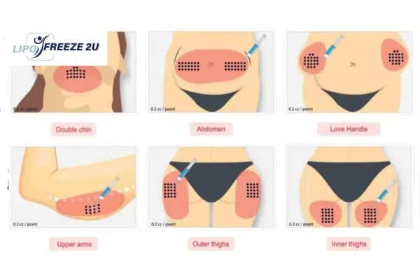 Benefits of Choosing Aqualyx for Fat Reduction Dorchester