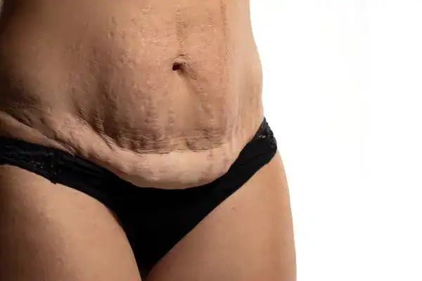 loose skin after weight loss injections Dorchester