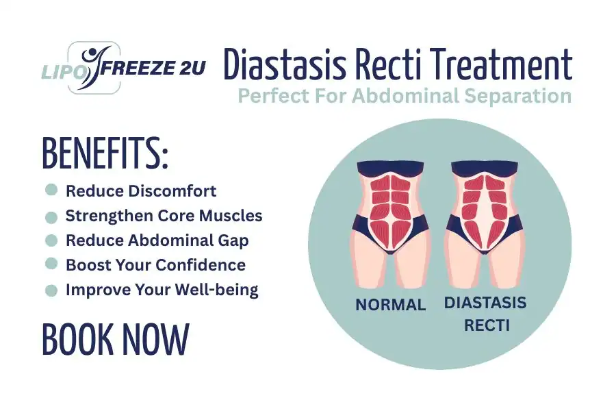 Benefits of body toning treatment Dorchester for Diastasis recti