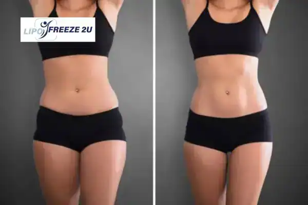 How Can LIPO FREEZE 2U Support Your Post-Pregnancy Body Recovery Dorchester?