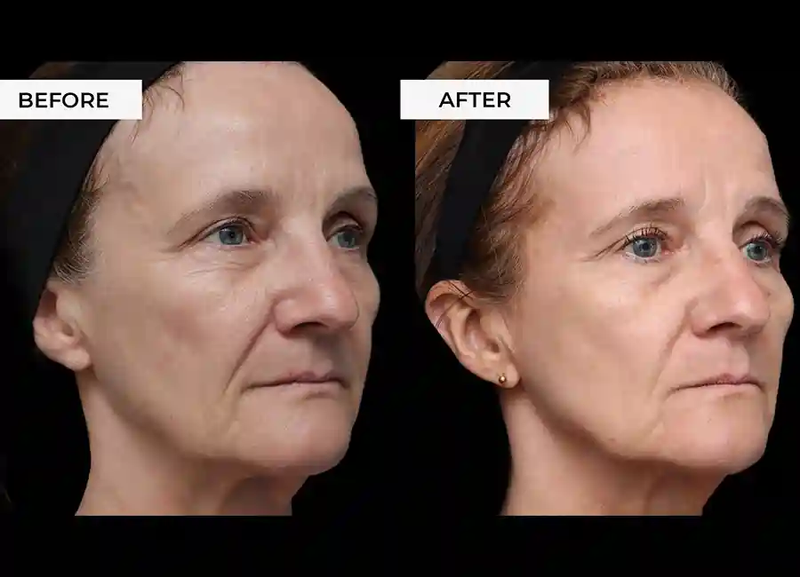 How Many RF Microneedling Sessions Will You Need to See a Difference Dorchester?