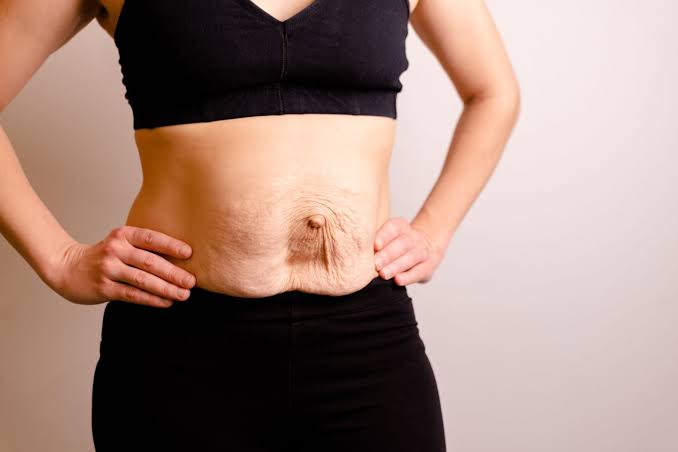 Is Surgery Really the Only Way to Repair Diastasis Recti Dorchester?
