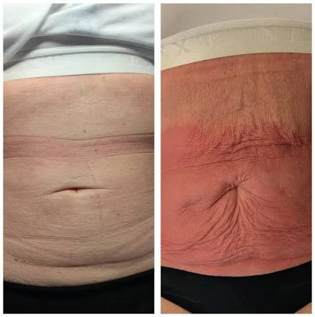 How Does RF Microneedling Improve Crepey, Thin and Uneven Skin Texture Dorchester?