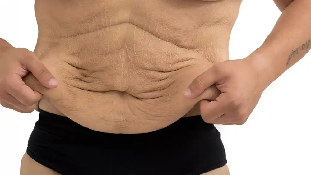 Why Does Weight Loss Medication Leave Some People With Loose or Sagging Skin Dorchester?